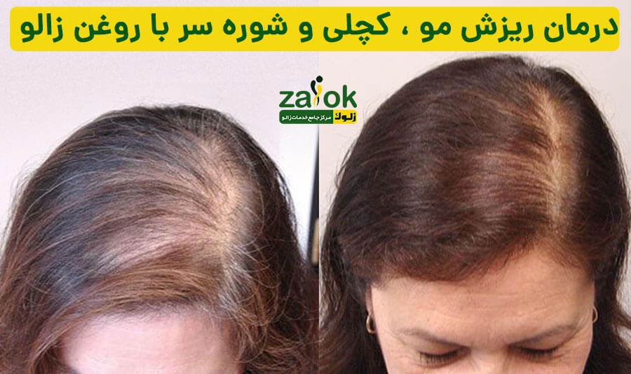 درمان ریزش مو با روغن زالو